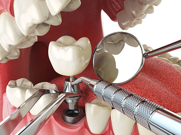Best Emergency Root Canal Treatment in Fairway, KS
